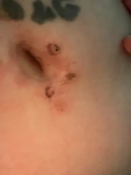 12 hours later (bellybutton ashtray)