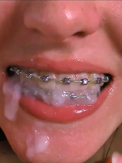 braces