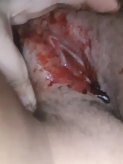 Bloody pussy