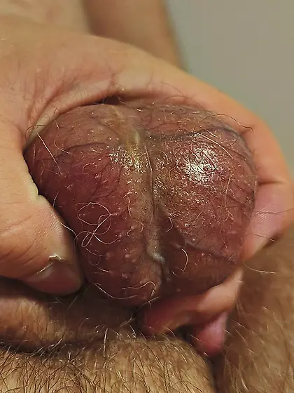 Scars of cutting my balls