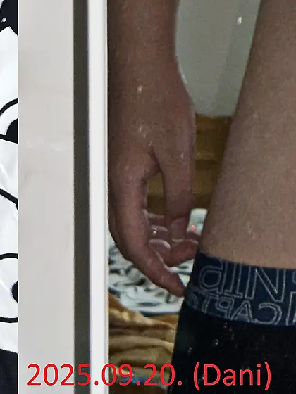 The amputation is not visible in underwear