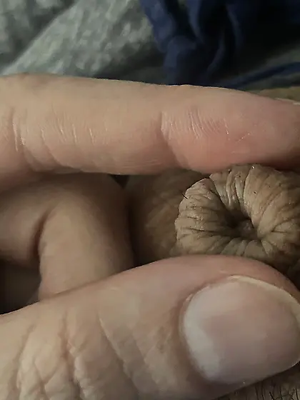 Tiny micropenis