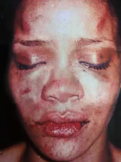 rihanna-bruises. jpg