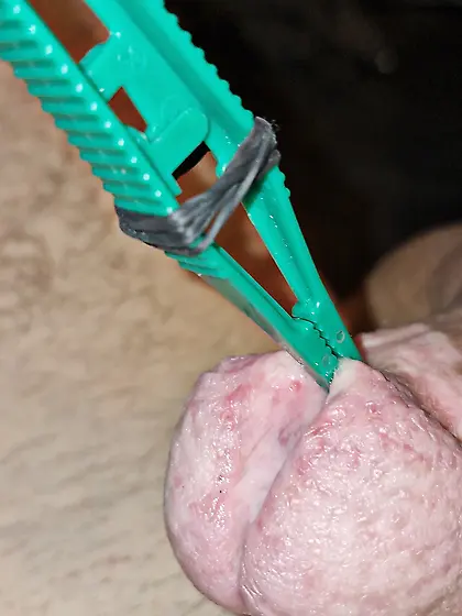 the slit of my glans is getting bigger