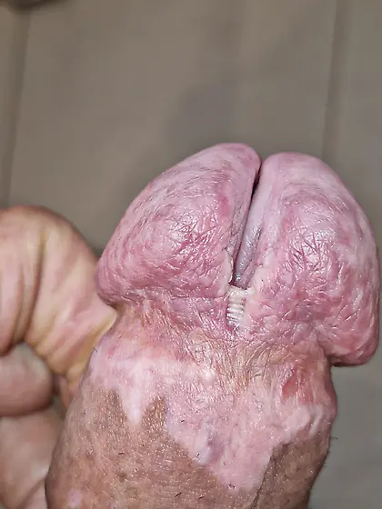 the slit of my glans is getting bigger