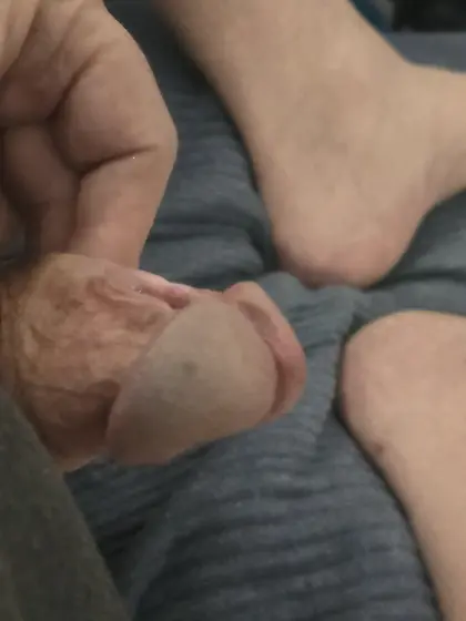 My split glans and subincision