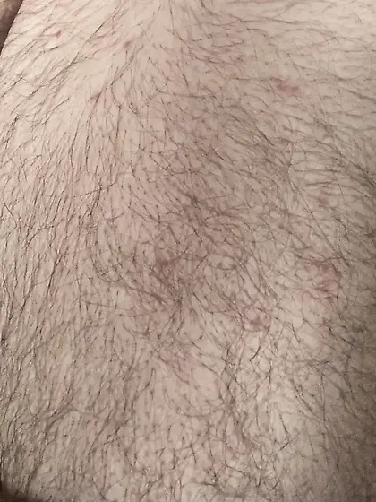 Micropenis is barely there