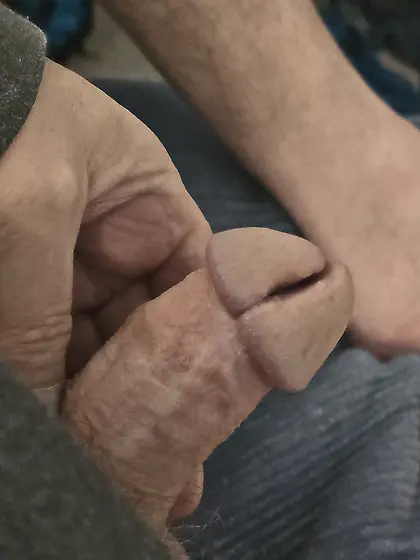 My split glans and subincision