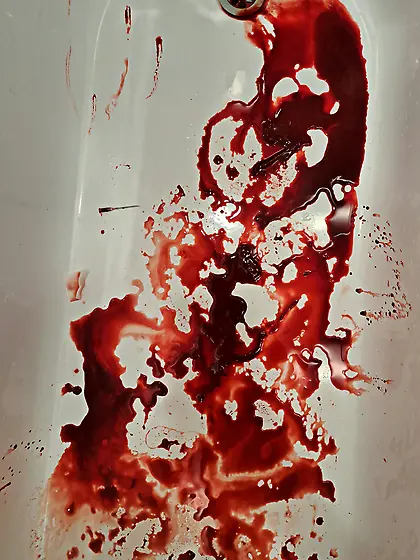 Aftermath of16G needle in my cockhead