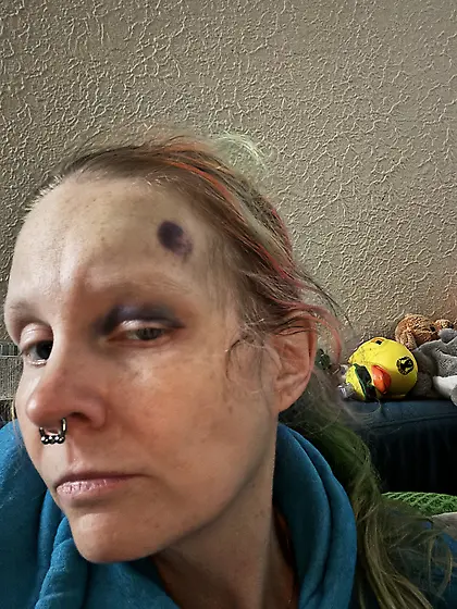 Fell and ended up with a black eye - ain’t it ni