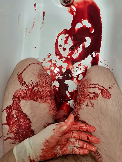 Aftermath of16G needle in my cockhead