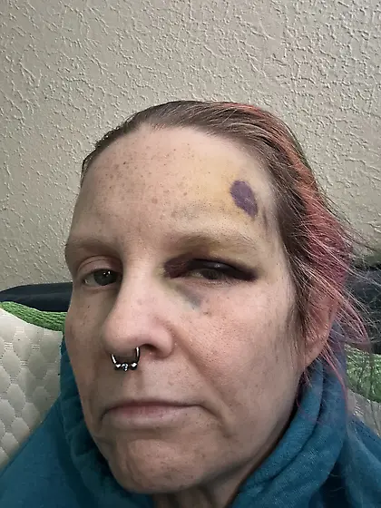 Fell and ended up with a black eye - ain’t it ni