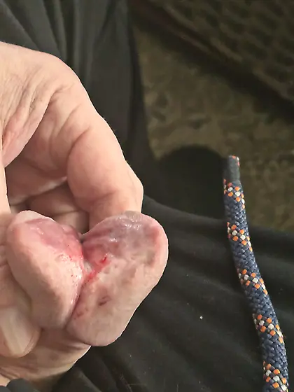 Cutting more of my glans