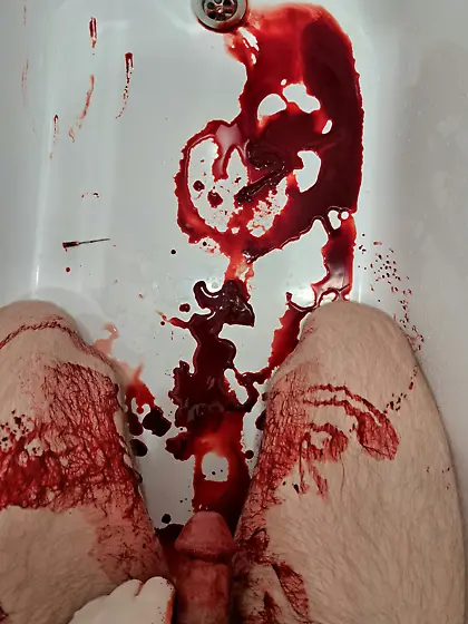 Aftermath of16G needle in my cockhead