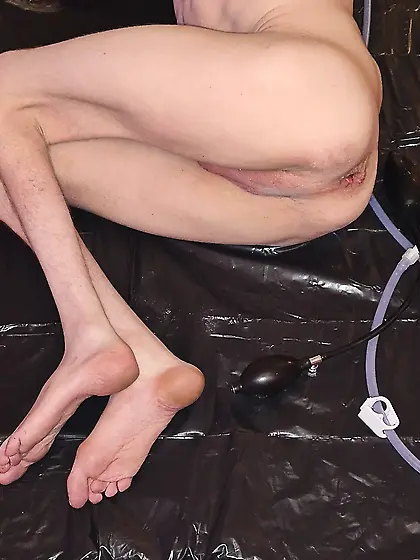 Crippled boy getting enema with inflatable plug