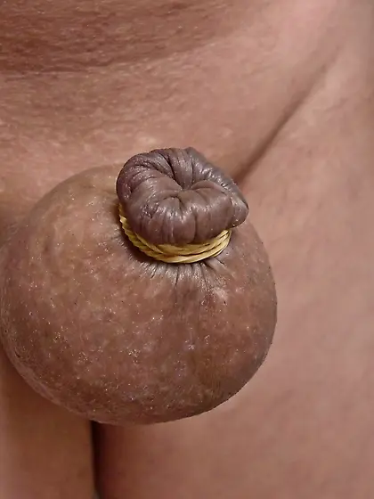 foreskin inflation