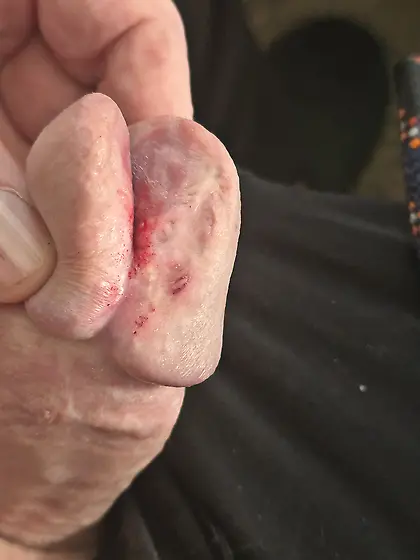 Cutting more of my glans