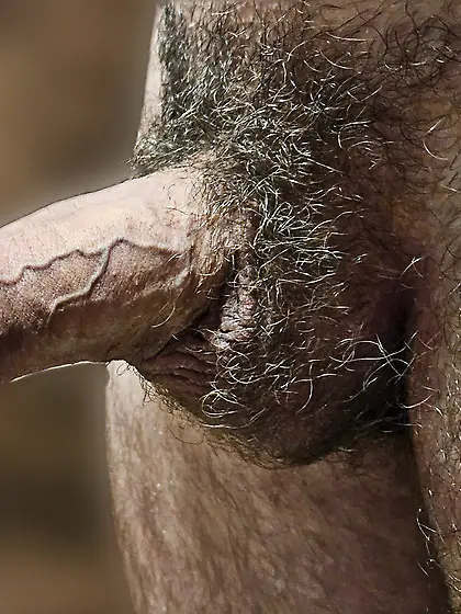 Unpulled foreskin