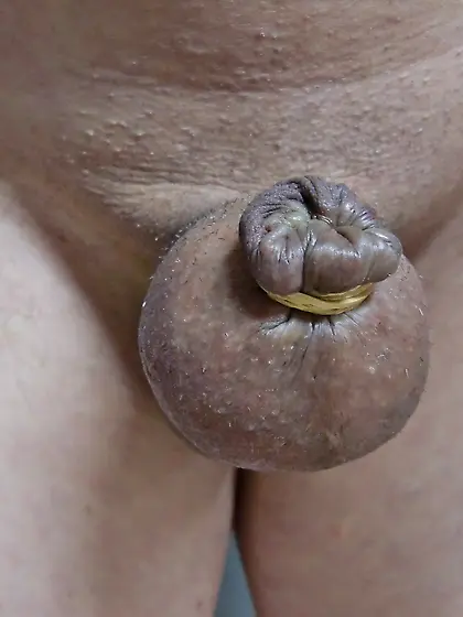 foreskin inflation