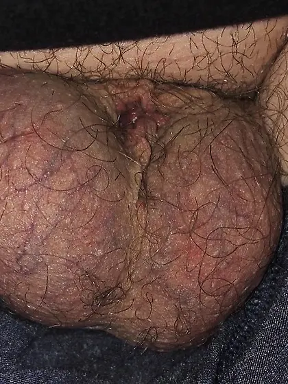 Dickless Bottom - post Penectomy