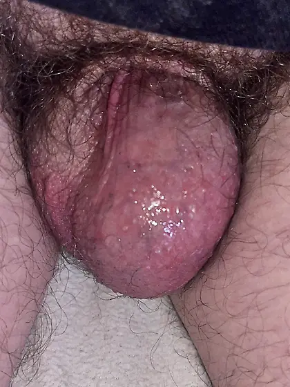 Dickless Bottom - post Penectomy