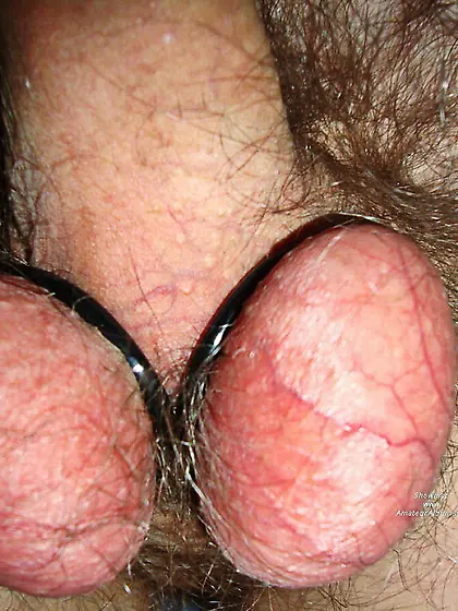 Rings stuck in a penis