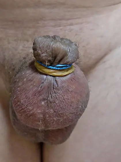 foreskin banding