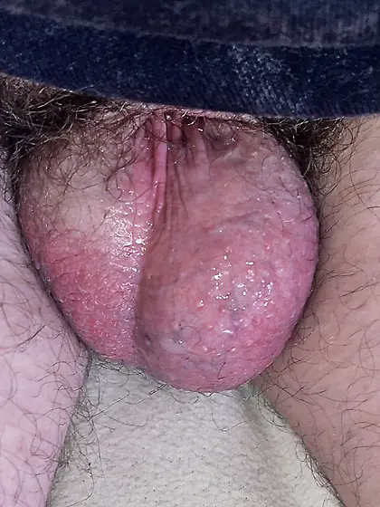 Dickless bottom - post Penectomy