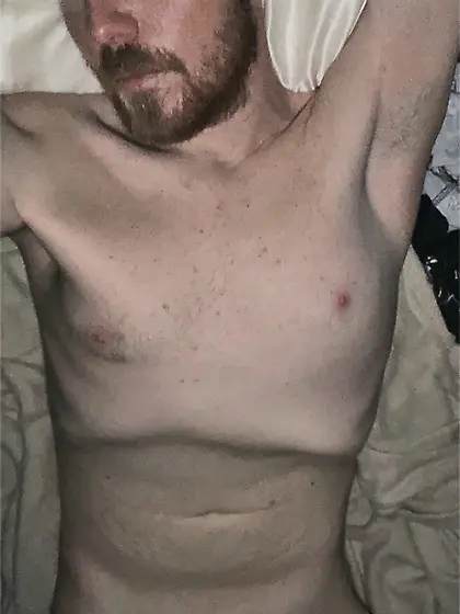 Dickless bottom - post Penectomy