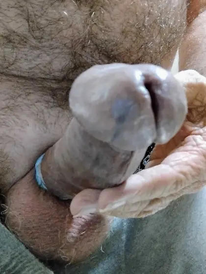Penectomy Penis