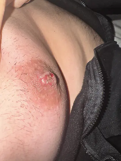 Nipple burn