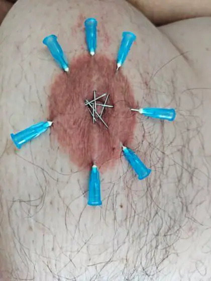 I had my nipples pierced with needles during a mee