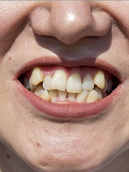 Crooked Teeth