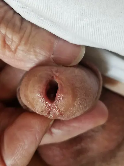 Urethral object insertion