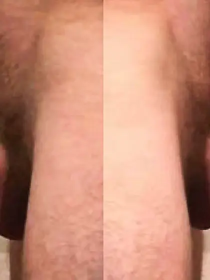 Deepthroat before and after