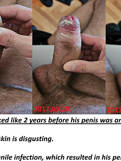 Dani's penis 2 years before the amputation