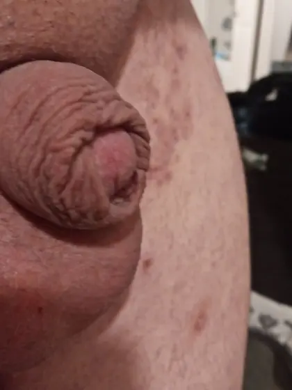 Regain your foreskin make your penis protected