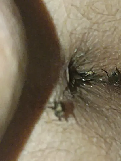 Flies on my anus in the village.  06. 2025