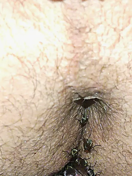 Flies on my anus in the village.  06. 2025