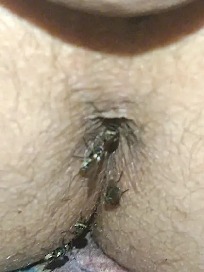 Flies on my anus in the village.  06. 2025