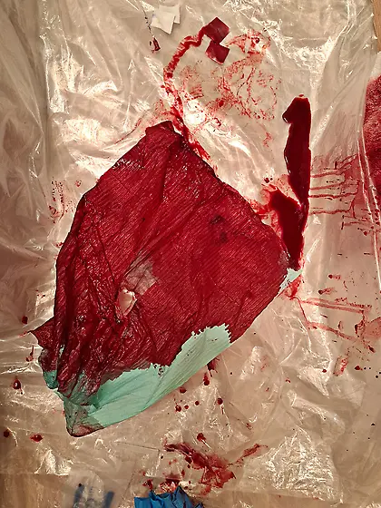 I impaled my cockhead with 18G needle the result