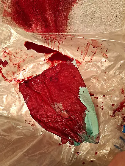 I impaled my cockhead with 18G needle the result