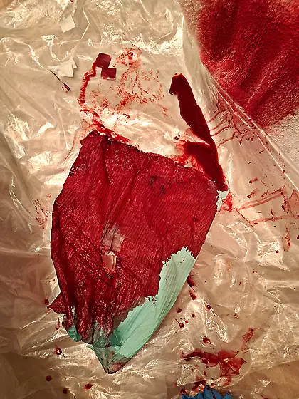 I impaled my cockhead with 18G needle the result